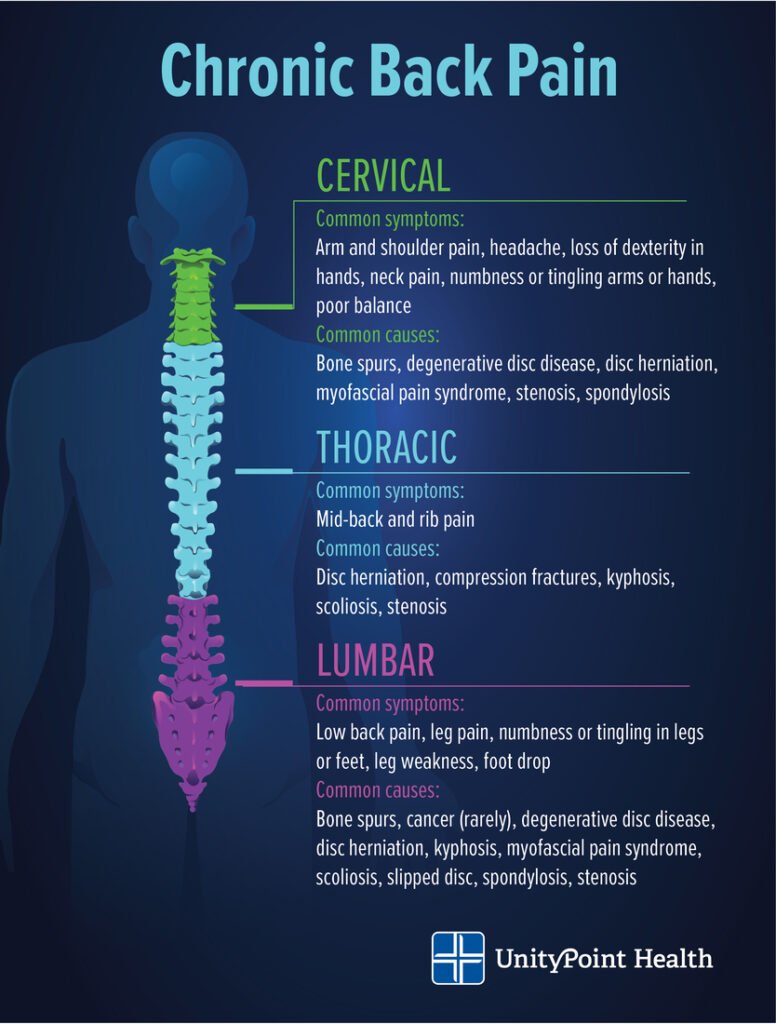 Lumbar disc bulge illustration showing nerve compression