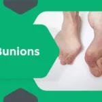 Bunion Treatment Case Study in Chennai: Advanced Foot and Ankle Care for Lasting Relief