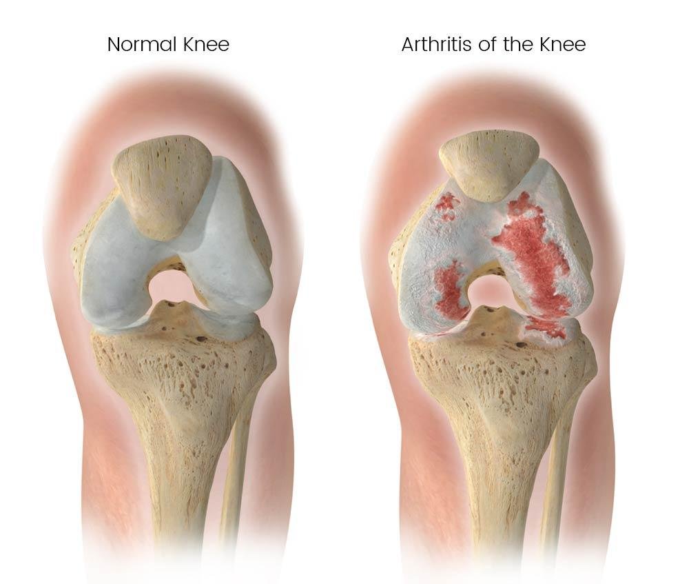 Illustration of knee osteoarthritis showing cartilage damage